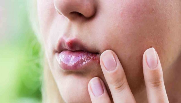 Uzmanı uyardı: Uçuk deyip geçmeyin, bakın neye sebep oluyor